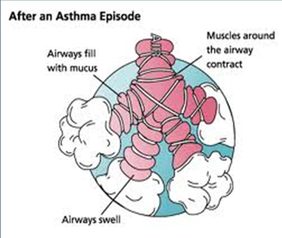 Asthma Patient has history of asthma and often a recognized inciting event (