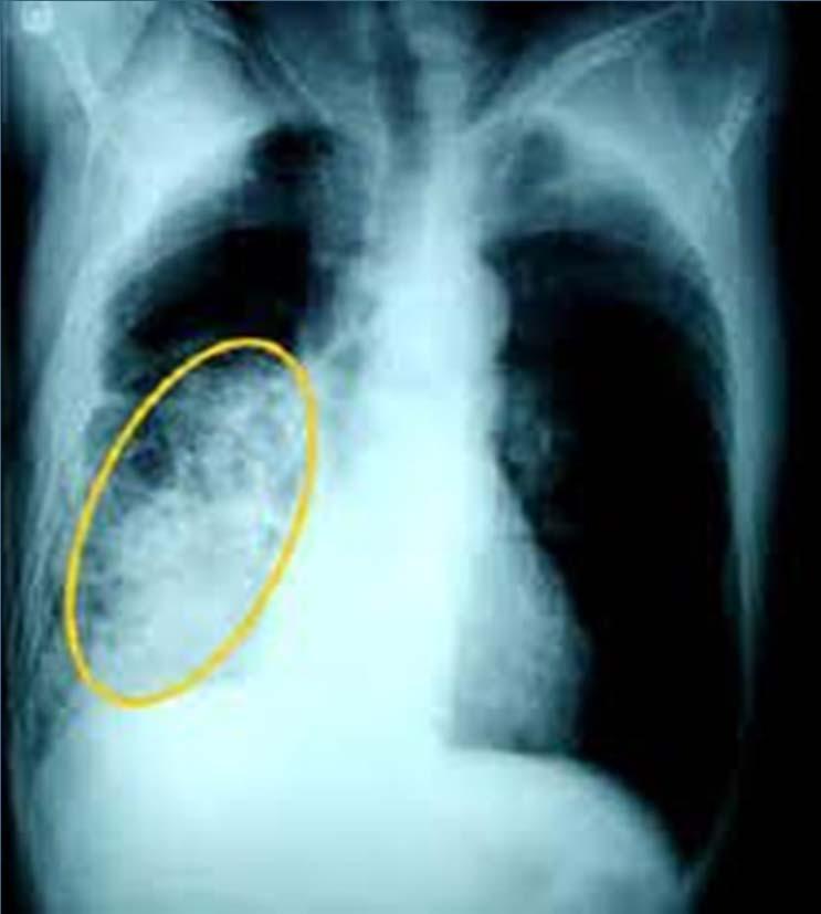 Pneumonia Bacterial, viral or fungal infection of the lung Generally a focal area of infection