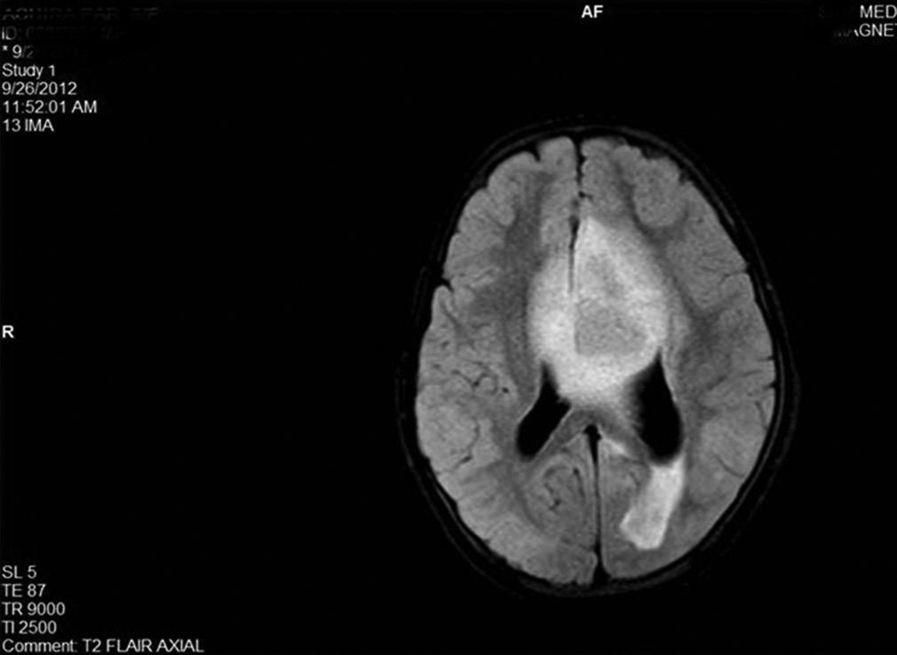 pressure, or localized neurologic deficits such as weakness, motor problems, and aphasia. Brain SOL has wide spectrum of lesions such as infective, vascular, and benign and malignant neoplasm.