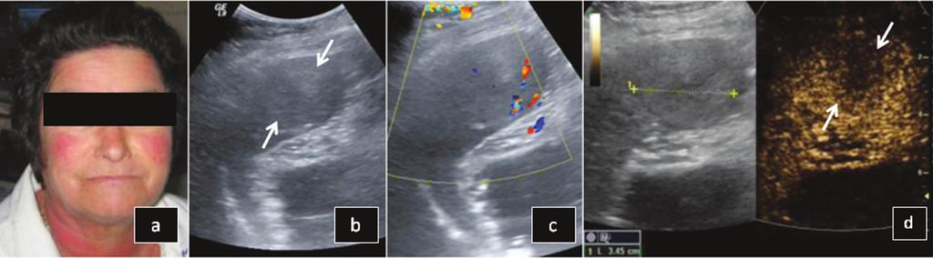 Contrast enhanced sonographic study of the spleen, p. 49-65 Fig. 10. Sarcoidosis: B mode US (a) reveals inhomogeneous echogenicity and ill-defined hypoechoic lesions.