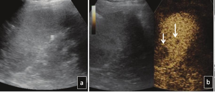 Fig. 12. Non-Hodgkin lymphoma: On B-mode US (a) the spleen shows inhomogeneous echogenicity, but no definitive lesion, thus CEUS followed, revealing multiple filling defects (arrows in b).