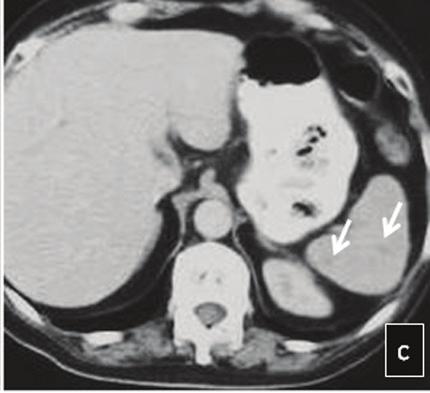 CEUS improved baseline US performance, by definitively detecting the splenic lesions, which were not evident before the contrast agent injection phomatous lesions may appear iso or hypoenhancing