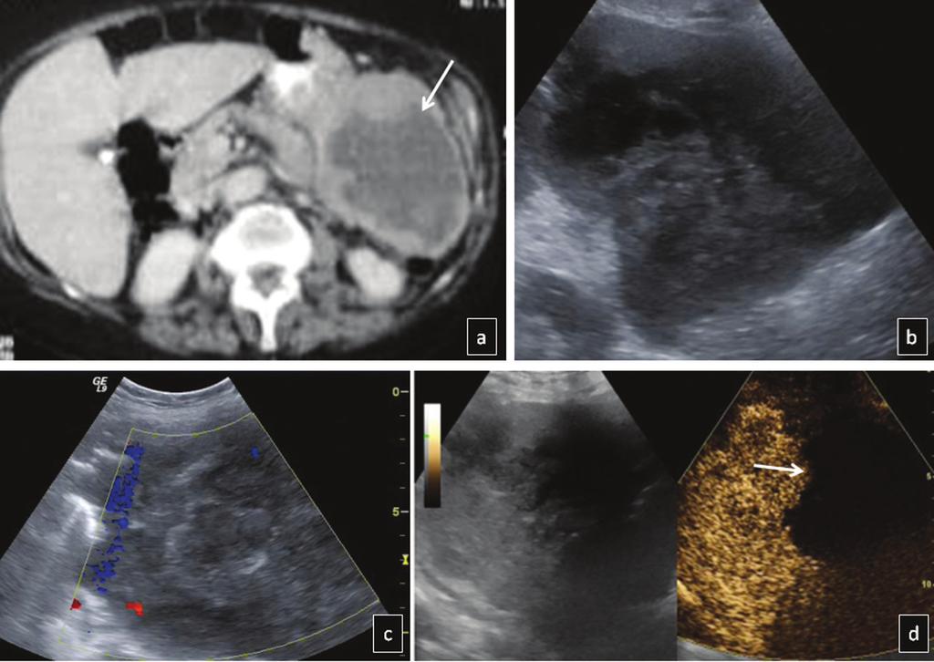 Contrast enhanced sonographic study of the spleen, p. 49-65 Fig. 13. Gastric lymphoma extends towards the spleen on CECT (arrow in a) performed in an outside institution.