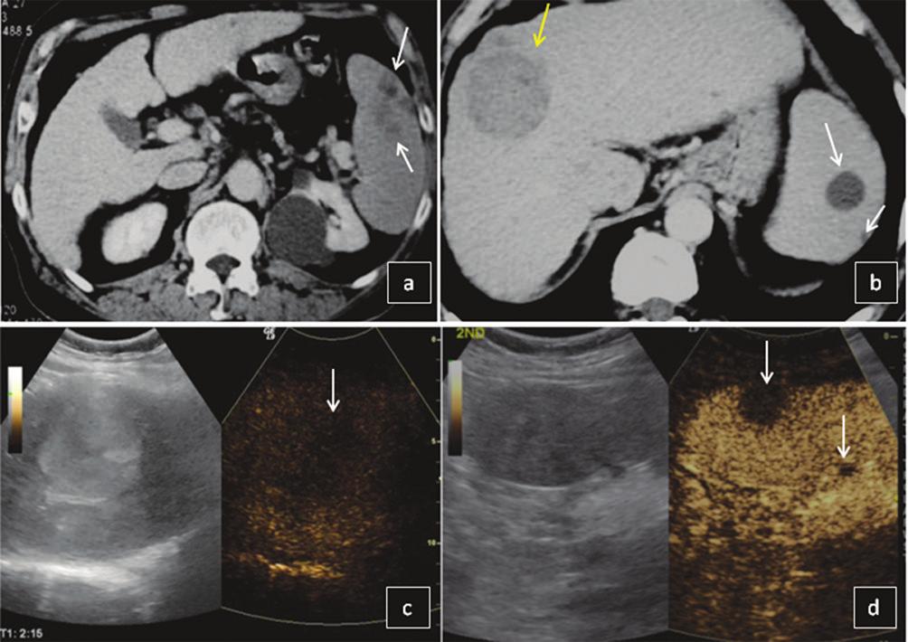 Fig. 14. Splenic metastases: An outside CECT (a, b) shows multiple uncharacterised splenic lesions (white arrows) and a known hepatocellular carcinoma (HCC-yellow arrow).