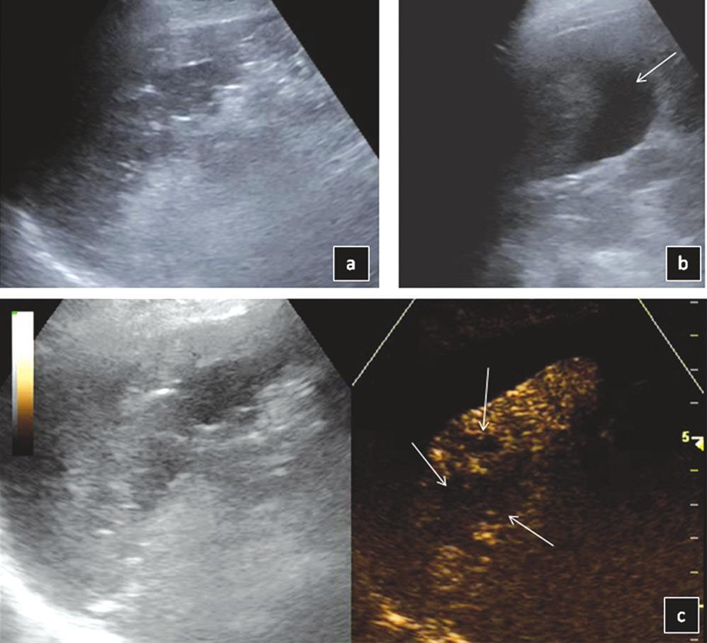Contrast enhanced sonographic study of the spleen, p. 49-65 Fig. 15.