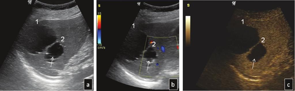 Contrast enhanced sonographic study of the spleen, p. 49-65 Fig. 1. Simple splenic cysts: B-mode (a) and colour Doppler US (b) show two anechoic cystic structures of the spleen.