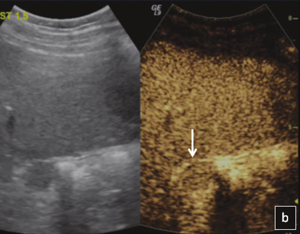 Fig. 2. Accessory spleen: A solid lesion is located in the splenic hilum on B-mode US (a).