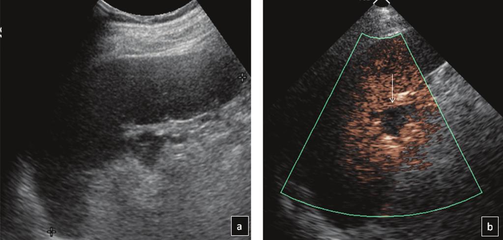 An accessory spleen (with similar appearance on B-mode US) would enhance parallel to the splenic parenchyma post contrast injection phase, the accessory spleen retains the contrast agent and appears