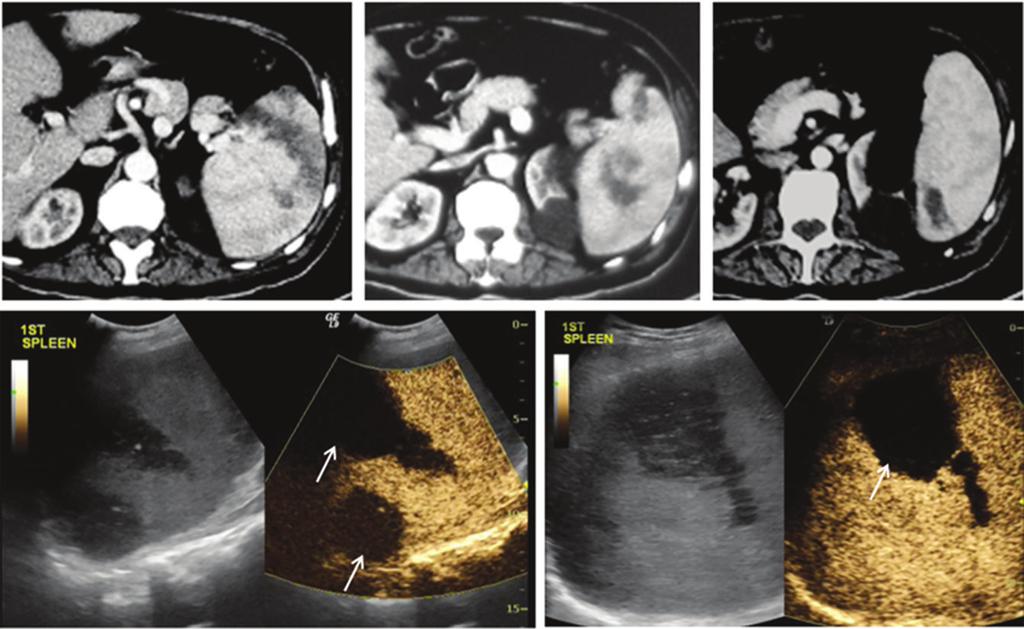 Contrast enhanced sonographic study of the spleen, p. 49-65 Fig. 4. CECT shows multiple splenic infarcts. CEUS performed 1.