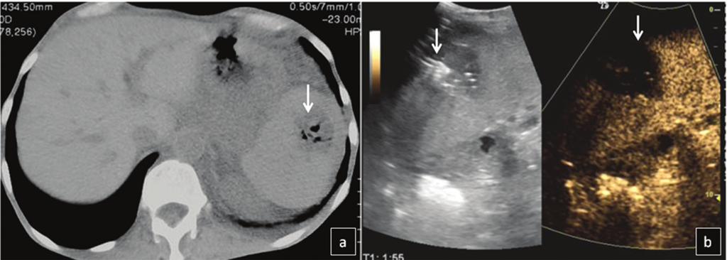 Follow up was performed only with CEUS useful in cancer patients who sometimes present with multiple small abscesses.