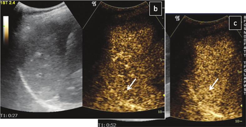 On colour Doppler US (a) there is suspicion of a large lesion in the upper part of the spleen (between arrows) with increased peripheral vasculature.