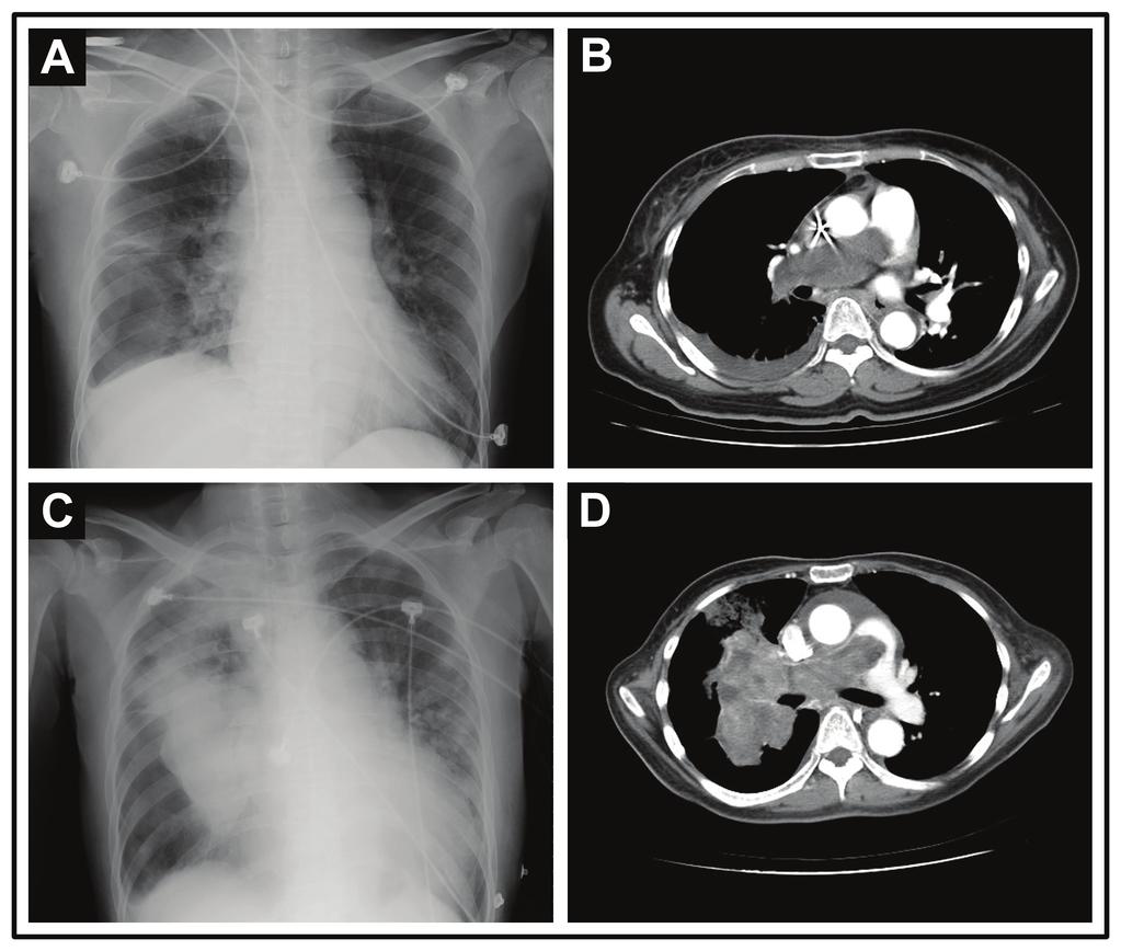 S. F. Cho et al./jcrp 28(2012) 35-40 37 Figure 1. (A-B) Imaging studies on initial presentation. (A) Chest radiography showed right-sided pleural effusion with suspected atelectasis.
