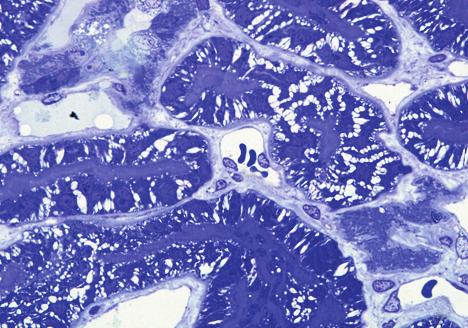 On pathologic examination, all patients revealed cytoplasmic foamy vacuolization and GL-3 deposition of podocytes, tubular epithelial cells, endothelial cells, and vascular smooth muscle cells, which