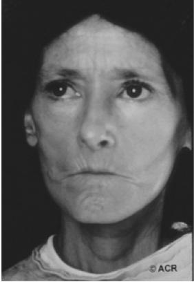 Sclerodactyly Scleroderma Facial Appearance