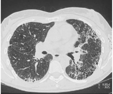 lung disease) Pulmonary fibrosis Prior to ACE inhibitors: >90%