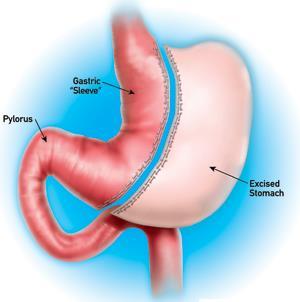 Sleeve Gastrectomy The Canadian Experience Condition Resolved Improved Type 2 DM n=19 Hypertension n=17 OSA n=21