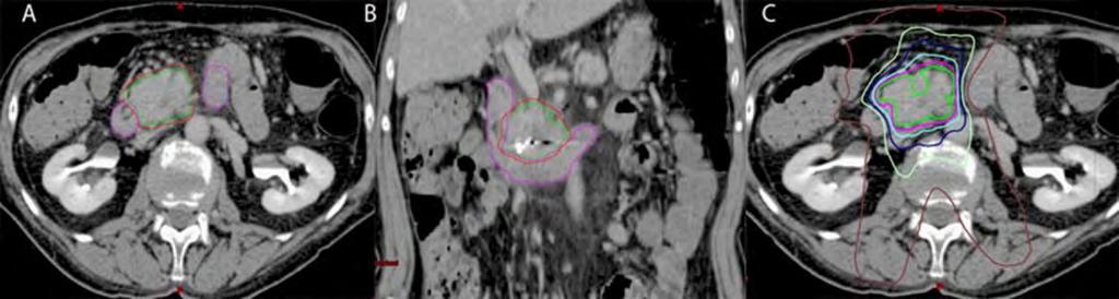 SBRT IN LOCALLY ADVANCED Representative pancreatic SBRT plan: (A) axial view showing pancreatic tumor (GTV: green), a typical PTV (red), and the duodenum (magenta); (B) coronal view demonstrating