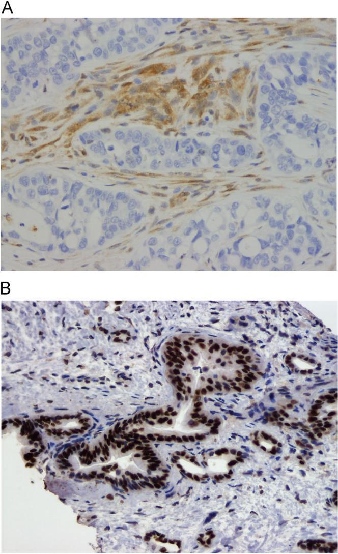 Immunolabeling Most ductal adenocarcinomas have abnormal nuclear labeling with antibodies to TP53, and 55% show a loss of Smad4 (PDC4) expression