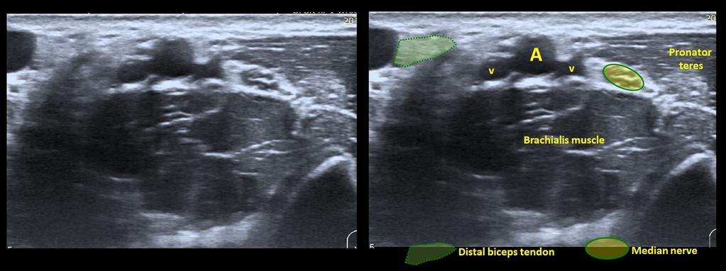 Fig. 5: Anterior elbow. Transverse view. Probe position.