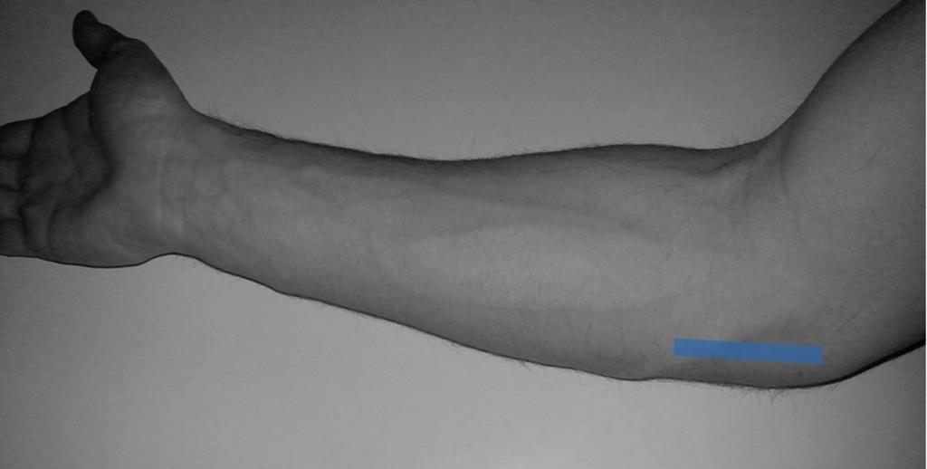 Common flexor tendon Medial collateral ligament Fig. 15: Medial elbow. Probe position.