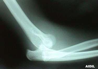Clinical Anatomy 1 Dislocation of the Elbow This occurs when the trochlear shifts from the