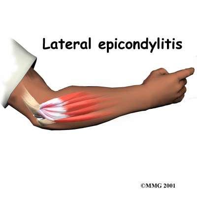 Lateral Epicondylitis - Tennis Elbow - Caused by excessive wrist