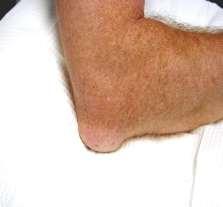 covers the posterior tip of the elbow.