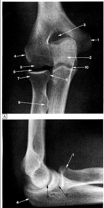 Joints of the Elbow Hinge joint Composed of 3 articulations: