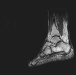 190 F. J. Slim et al. Figure 1. MRI after follow-up with interruption of the subcutaneous fat plantar to the 5th metatarsal joint.