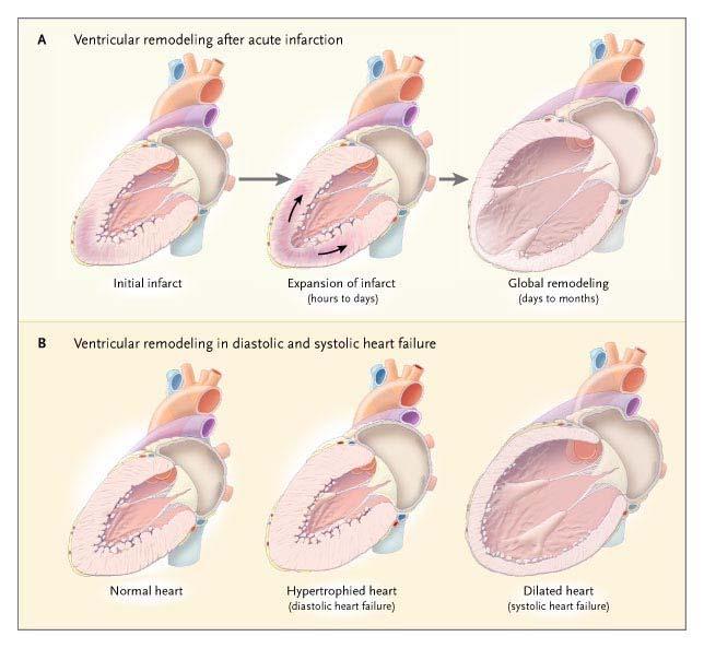 Ventricular Remodeling Laplace s Law Where P = ventricular
