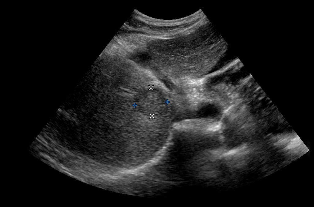 ULTRASOUND Our Patient: Screening Liver Ultrasound