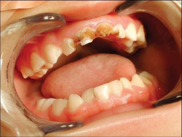 CDA Position on Early Childhood Caries ECC is an infectious, transmissible, diet-dependent disease that may begin soon after dental eruption and that may progress rapidly.