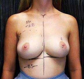 breast mass