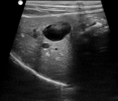 landmark. The liver will appear more wedge shaped Mid Liver - Look for the portal vein as a landmark.