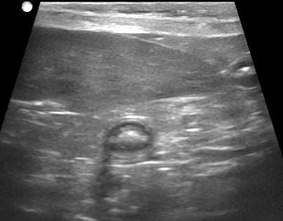 Mid Spleen - Image should be taken at the hilum where the splenic vein can be seen (split screen with color) Splenic