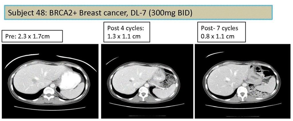 Veliparib (ABT 888) in gbrca mutated cancer.