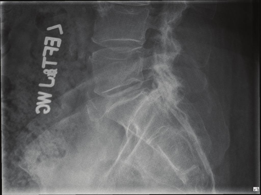 2 Figure 1: Lateral lumbar X-ray normal lumbosacral alignment and anatomy.