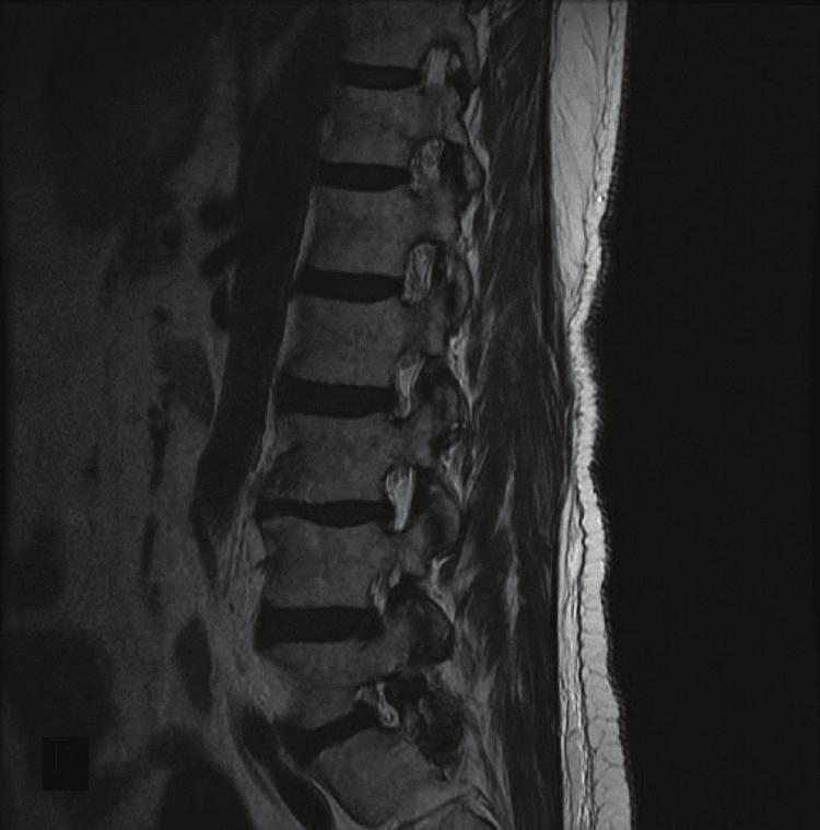 Discussion We present a case of a lumbar synovial cyst that on imaging and at surgery did not appear in proximity or continuous with the ipsilateral L5-S1 facet joint.