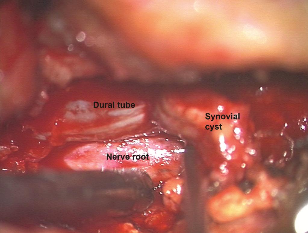 The cyst resulted in adjacent nerve root compression and following cyst resection there was improvement in the radicular symptoms.