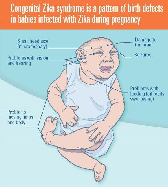 Summary Zika virus infection diagnosed during any trimester of pregnancy poses a risk to the fetus The absence or presence of symptoms in patients with confirmed Zika virus infection does not appear