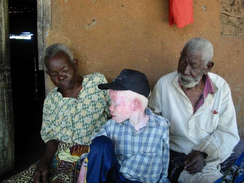 Albino Skin Pigmentation Person