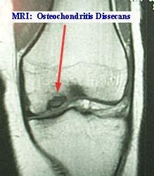 Osteochondritis Dissecans (OCD) Teen patient Localized avascular necrosis usually of the lateral