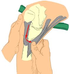 Pes Anserine Bursitis Bursa that allows the tendons to slide past tibia and MCL