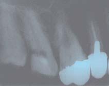 Case 2 Pulpectomy and endodontic treatment of