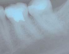 Case 3 Endodontic treatment of a second lower