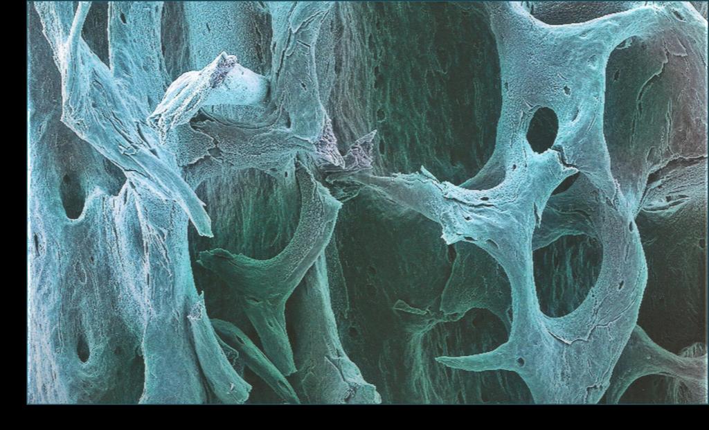 Osteoporosis Effects on bone mineral density: Premature bone