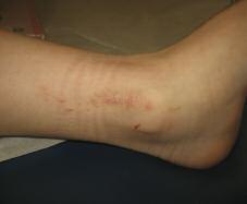Case 12 Unilateral Dermatitis on Lower Leg A four-year-old girl presents with linear erythematous, nonpruritic papules over the lower leg, which have been present for the past four weeks.