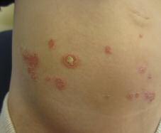 Case 2 Red, Scaly Plaques on the Abdomen A two-year-old girl presents with multiple red and scaly plaques on her abdomen. a. Guttate psoriasis b. Impetigo c. Scabies d. Nummular dermatitis e.