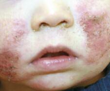 Case 5 Erosive, Crusted Skin on Cheeks A 12-month-old boy is brought to the clinic by his mother because of itchy, erythematous, red, erosive, crusted skin over both cheeks of two months duration.