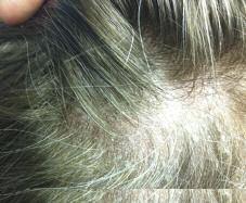 Case 6 Scaly Lesions on the Scalp This 51-year-old female with generalized, pruritic, scaly lesions on the scalp, associated with some hair loss over a period of a few months, presents to the clinic.
